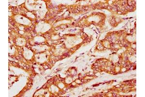 IHC image of ABIN7165686 diluted at 1:400 and staining in paraffin-embedded human colon cancer performed on a Leica BondTM system. (PACSIN2 antibody  (AA 240-410))