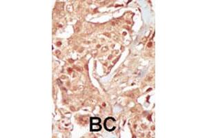 Formalin-fixed and paraffin-embedded human cancer tissue reacted with PCTK3 polyclonal antibody  , which was peroxidase-conjugated to the secondary antibody, followed by DAB staining. (CDK18 antibody  (N-Term))