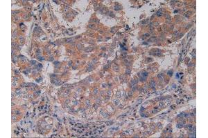 IHC-P analysis of Human Breast Cancer Tissue, with DAB staining. (CD40 antibody  (AA 26-187))