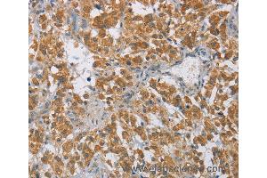 Immunohistochemistry of Human cervical cancer using DIDO1 Polyclonal Antibody at dilution of 1:60