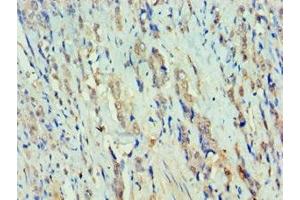 Immunohistochemistry of paraffin-embedded human colon cancer using ABIN7150384 at dilution of 1:100 (RFX5 antibody  (AA 367-616))