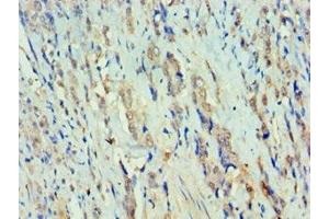 Immunohistochemistry of paraffin-embedded human colon cancer using ABIN7150384 at dilution of 1:100