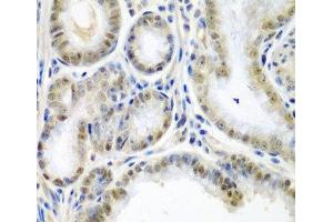 Immunohistochemistry of paraffin-embedded Human colon carcinoma using SSX2 Polyclonal Antibody at dilution of 1:200 (40x lens). (SSX2 antibody)