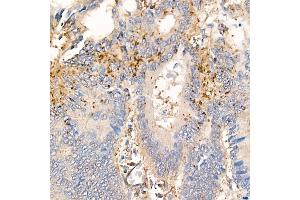 Immunohistochemistry of paraffin-embedded human colon carcinoma using MMP7 Rabbit mAb (ABIN7268425) at dilution of 1:150 (40x lens). (MMP7 antibody)