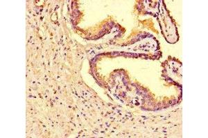Immunohistochemistry of paraffin-embedded human prostate cancer using ABIN7171500 at dilution of 1:100 (TNKS2 antibody  (AA 1-246))