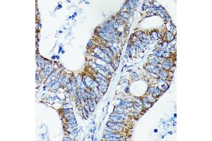 Immunohistochemistry of paraffin-embedded human colon carcinoma using TNF Rabbit mAb (ABIN7271076) at dilution of 1:100 (40x lens). (TNFAIP3 antibody)