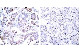 Immunohistochemistry analysis of paraffin-embedded human breast carcinoma tissue, using NF-kappaB p65 (Ab-254) Antibody. (NF-kB p65 antibody  (AA 221-270))