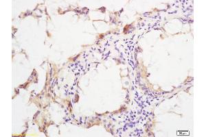Formalin-fixed and paraffin embedded human rectal carcinoma labeled with Rabbit Anti phospho-SHC(Ser36) Polyclonal Antibody, Unconjugated (ABIN745913) at 1:200 followed by conjugation to the secondary antibody and DAB staining (SHC1 antibody  (pSer36))