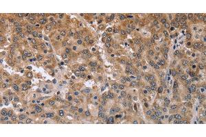Immunohistochemistry of paraffin-embedded Human liver cancer using MAPRE3 Polyclonal Antibody at dilution of 1:50 (MAPRE3 antibody)