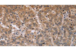 Immunohistochemistry of paraffin-embedded Human liver cancer using MAPRE3 Polyclonal Antibody at dilution of 1:50