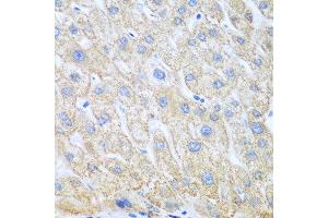 Immunohistochemistry of paraffin-embedded human liver cancer using PTGS1 antibody at dilution of 1:100 (40x lens). (PTGS1 antibody)
