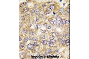 Formalin-fixed and paraffin-embedded human hepatocarcinoma tissue reacted with CHRD antibody , which was peroxidase-conjugated to the secondary antibody, followed by DAB staining. (Chordin antibody  (C-Term))