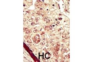 Formalin-fixed and paraffin-embedded human cancer tissue reacted with the primary antibody, which was peroxidase-conjugated to the secondary antibody, followed by DAB staining. (STK16 antibody  (C-Term))