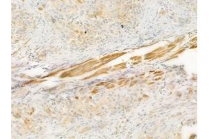 ABIN6257061 and ABIN6274183 at 1/100 staining human tongue carcinoma by IHC-P.