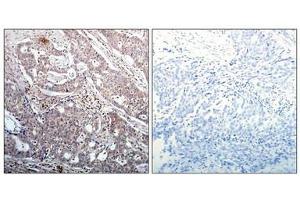 Immunohistochemical analysis of paraffin-embedded human breast carcinoma tissue using IkB-b(Phospho-Ser23) Antibody(left) or the same antibody preincubated with blocking peptide(right). (NFKBIB antibody  (pSer23))