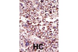 Formalin-fixed and paraffin-embedded human hepatocellular carcinoma tissue reacted with RPN2 polyclonal antibody  , which was peroxidase-conjugated to the secondary antibody, followed by DAB staining . (Ribophorin II antibody  (N-Term))