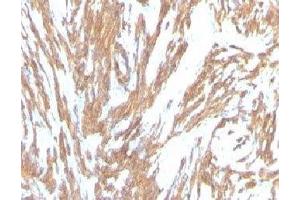 Formalin-fixed, paraffin-embedded human Leiomyosarcoma stained with alpha Smooth Muscle Actin antibody (ACTA2/791).