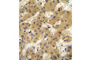 OF antibody (Center) 10107c immunohistochemistry analysis in formalin fixed and paraffin embedded human hepatocarcinoma followed by peroxidase conjugation of the secondary antibody and DAB staining. (Apolipoprotein F antibody  (AA 111-138))