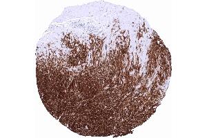 Dog1 Tumor periphery of a GIST showing intensive DOG1 staining in all tumor cells (ANO1 antibody  (AA 2-101))