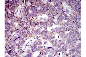 Immunohistochemical analysis of paraffin-embedded esophageal cancer tissues using MRPL42 mouse mAb with DAB staining.