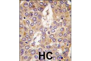 Formalin-fixed and paraffin-embedded human hepatocarcinoma tissue reacted with CK1g2 antibody , which was peroxidase-conjugated to the secondary antibody, followed by DAB staining. (Casein Kinase 1 gamma 2 antibody  (C-Term))