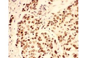 IHC-P: BRCA1 antibody testing of human breast cancer tissue (BRCA1 antibody  (AA 1661-1863))