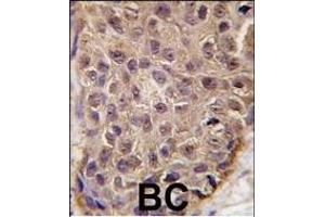 Formalin-fixed and paraffin-embedded human breast carcinoma tissue reacted with OAS1 antibody (C-term), which was peroxidase-conjugated to the secondary antibody, followed by DAB staining. (OAS1 antibody  (C-Term))