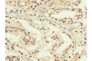 IHC image of ABIN7166949 diluted at 1:200 and staining in paraffin-embedded human prostate cancer performed on a Leica BondTM system. (GDI1 antibody  (AA 35-170))