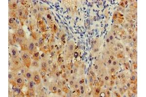 Immunohistochemistry of paraffin-embedded human liver tissue using ABIN7171273 at dilution of 1:100 (SDCBP antibody  (AA 21-228))