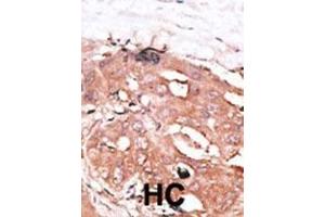 Formalin-fixed and paraffin-embedded human cancer tissue reacted with the primary antibody, which was peroxidase-conjugated to the secondary antibody, followed by DAB staining. (ATG4D antibody  (N-Term))