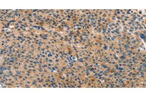 Immunohistochemistry of paraffin-embedded Human liver cancer tissue using ANXA10 Polyclonal Antibody at dilution 1:35 (Annexin a10 antibody)