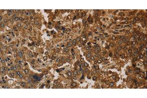 Immunohistochemistry of paraffin-embedded Human liver cancer using CK-16 Polyclonal Antibody at dilution of 1:30 (KRT16 antibody)