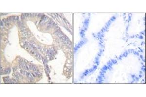 Immunohistochemistry analysis of paraffin-embedded human colon carcinoma tissue, using Gastrin Antibody. (Gastrin antibody  (AA 52-101))