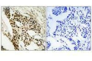 Immunohistochemistry analysis of paraffin-embedded human breast carcinoma tissue using MAPKAPK2 (Ab-272) antibody. (MAPKAP Kinase 2 antibody  (Ser272))