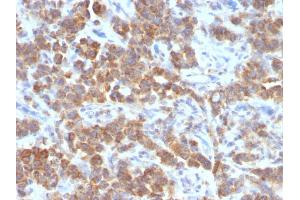 Formalin-fixed, paraffin-embedded human Parathyroid Mass stained with TNFS15 / VEGI Monoclonal Antibody (VEGI /1283). (TNFSF15 antibody)