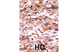 Immunohistochemistry (Paraffin-embedded Sections) (IHC (p)) image for anti-Cell Division Cycle 25 Homolog A (S. Pombe) (CDC25A) (pSer124) antibody (ABIN389527)