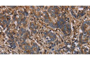 Immunohistochemistry of paraffin-embedded Human liver cancer using FLNA Polyclonal Antibody at dilution of 1:40 (Filamin A antibody)