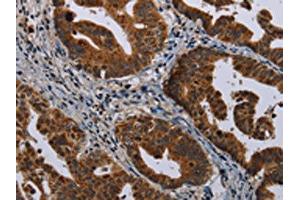 The image on the left is immunohistochemistry of paraffin-embedded Human gastic cancer tissue using ABIN7191351(MAGEB3 Antibody) at dilution 1/20, on the right is treated with synthetic peptide. (MAGEB3 antibody)