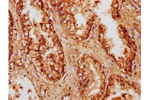 IHC image of ABIN7148132 diluted at 1:500 and staining in paraffin-embedded human prostate cancer performed on a Leica BondTM system. (CCDC6 antibody  (AA 347-440))