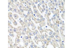 Immunohistochemistry of paraffin-embedded Human liver damage using OTC Polyclonal Antibody at dilution of 1:100 (40x lens). (OTC antibody)