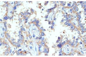 Immunohistochemistry of paraffin-embedded Human lung cancer using CD47 Polyclonal Antibody at dilution of 1:200 (40x lens). (CD47 antibody)