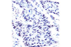 Immunohistochemistry of paraffin-embedded human esophageal cancer using p63 antibody (ABIN3023011, ABIN3023012, ABIN3023013, ABIN1513632 and ABIN6219346) at dilution of 1:50 (40x lens). (p63 antibody  (AA 421-680))