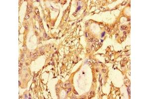 Immunohistochemistry of paraffin-embedded human pancreatic cancer using ABIN7172704 at dilution of 1:100 (SUPT3H/SPT3 antibody  (AA 1-328))