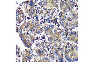 Immunohistochemistry of paraffin-embedded Human liver cancer using SENP1 Rabbit pAb (ABIN6132646, ABIN6147534, ABIN6147536 and ABIN6216945) at dilution of 1:100 (40x lens). (SENP1 antibody  (AA 220-420))