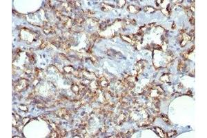 Formalin-fixed, paraffin-embedded human Angiosarcoma stained with CD31 antibody (JC/70A)