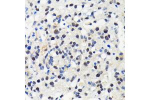 Immunohistochemistry of paraffin-embedded human oophoroma using Cullin 3 antibody (ABIN7266543) at dilution of 1:100 (40x lens). (Cullin 3 antibody)