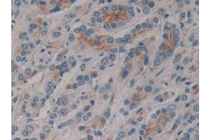 DAB staining on IHC-P; Samples: Human Prostate cancer Tissue (CD1e antibody  (AA 39-276))