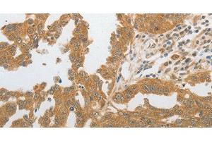 Immunohistochemistry of paraffin-embedded Human ovarian cancer tissue using GRIN2C Polyclonal Antibody at dilution 1:80 (GRIN2C antibody)