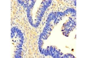 Immunohistochemistry of paraffin-embedded human ovarian cancer using ABIN7174304 at dilution of 1:100