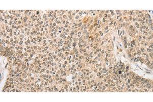 Immunohistochemistry of paraffin-embedded Human lung cancer tissue using RPL26L1 Polyclonal Antibody at dilution 1:30 (RPL26L1 antibody)